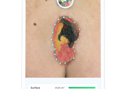 WoundTrack II AI wound analysis