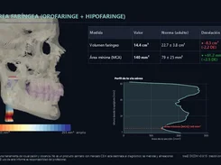 A Spanish airway-analysis report showing a lateral skull rendering, pharyngeal volume and minimum-area values, and an airway profile chart.