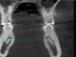 A coronal dental CT image with colored distance and angle measurements and a small axial orientation inset.