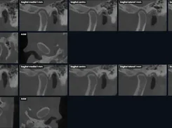A dark report-style layout containing multiple labeled sagittal, coronal, and axial CT views of the jaw joint on both sides.