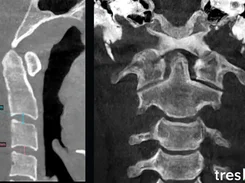 Two CT views of the cervical spine, including colored millimeter measurements on the left image, with a tresD DICOM viewer logo.