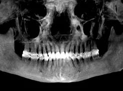 A panoramic dental radiograph displayed on a dark background with a tresD DICOM viewer logo.