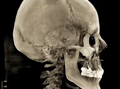 A lateral 3D CT reconstruction of a skull, jaw, and upper cervical spine on a black background with a millimeter scale.