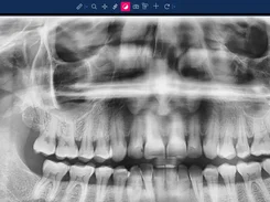 Panoramic dental radiograph shown beneath a dark-blue imaging toolbar.